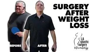 Surgery After 150lb Weight Loss | Tummy Tuck And Facial Rejuvenation