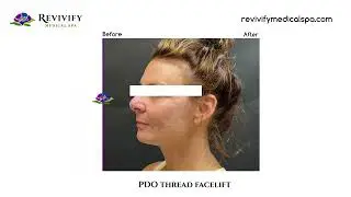 PDO Thread Facelift Before & After - Revivify Medical Spa Beaumont, TX