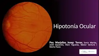 Hipotonía Ocular - Maculopatía Hipotónica: Fisiopatología, Hallazgos Clínicos y Tratamiento.