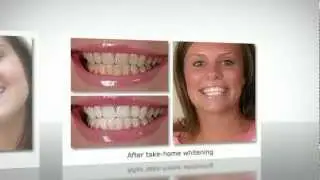 Teeth Whitening Anchorage | Smile Makeover | Call 907-278-6684