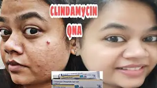 🟥Dermatologist Recommended Best Gel For 🙎&zwj;♀️Acne | Q n A Clindamycin gel for Acne