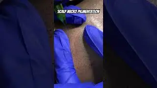 Scalp micropigmentation in India 🇮🇳 8891426652 8078800335 #scalpmicropigmentation #hair #smp