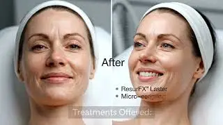 New Touch - Acne Scar Reduction Treatment