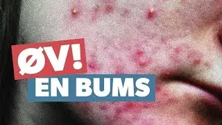Derfor f&aring;r du bumser