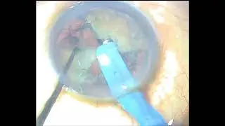 Topical MICS PHACO cataract surgery 
