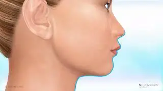 Carriere Motion with Aligners