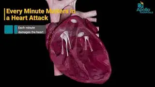 Angioplasty Explained | Symptoms, Procedure & Benefits