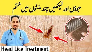 Head Lice Treatment - Sar Ki Juen Khatam Karne Ka Tarika - Dr Irfan Azeem