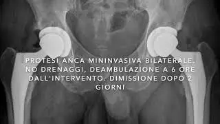 La protesi mininvasiva bilaterale dell'anca