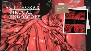 🔬 CT Thorax Virtual Endoscopy | Siemens 96-Slice 🩻