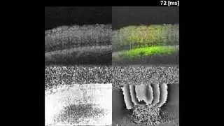 Biomedical Optics Express : Two-dimensional micro-displacement measurement for laser coagulation...
