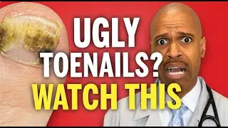 How To Cure Toenail Fungus