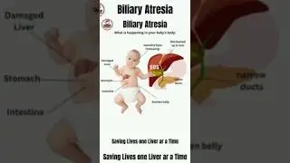 Biliary Atresiya -what 's happening in your baby's body? #biliaryatresia #liverhealth #childhealth..