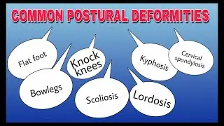 Common Postural Deformities. CERVICAL|LORDOSIS|KYPHOSIS|SCOLIOSIS|KNOCKED KNEES|BOWED LEGS|FLAT FOOT