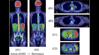 Application of Single Proton Emission tomography in diagnosis of musculoskeletal system disease