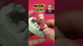 Missing Teeth? This is a Cheaper Solution.