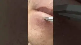 Plucking Out a White Beard Hair &ndash; So Satisfying! #hairremoval #beardplucking #tweezers