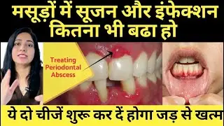 मसूड़ों की सूजन और इंफैक्शन को करे जड़ से खत्म | Eliminate Gum Swelling And Infection From Its Roots