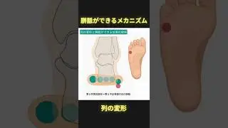 胼胝ができるメカニズム：列の変形 #理学療法 #ptタイガー #足病学