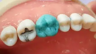 Fabrication of wax pattern (upper molar)