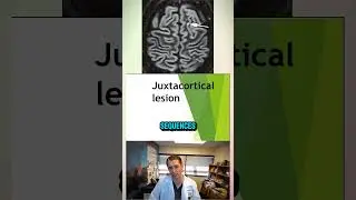 Multiple Sclerosis Juxtacortical Lesions