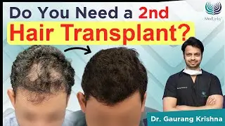 Do You Need a 2nd Hair Transplant? Cases When & Where Multiple Hair Transplant Sessions Are Required