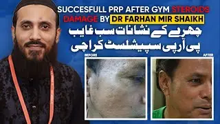 Side Effects Of Using Steroids Damaged To Smooth Skin | Successful PRP | Dr Farhan Mir | Pt. Reviews