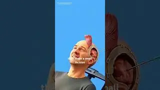 How Craniotomy Surgery Is Performed (3D animation) #music #motivation #epic #like