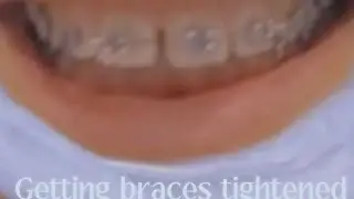 Getting braces tightened~Darcy pamper+Riding henri again after fall/Happy Horses Shaila