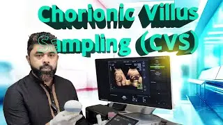 Chorionic Villus Sampling (CVS) Explained by Dr. Saiful Islam Saif Sonography