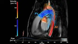 4D flow MRI visualization of pulmonary and aortic valve insufficiency