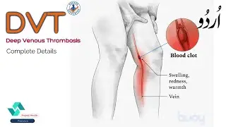 DVT Complete Details In Urdu   Deep Vein Thrombosis