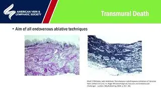 6 months outcomes from SONOVEIN echotherapy presented by Prof Whiteley at AVLS 2020