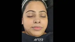 o3+ shine & glow facial done by me 🤩 before and after result.