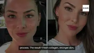 Microneedling in Dallas, TX: Top Benefits for Your Skin
