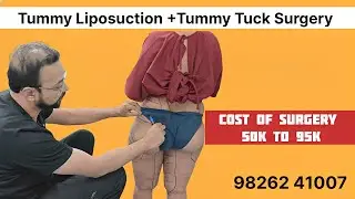 Liposuction In Mumbai | Tummy Liposuction Surgery In Mumbai | Before After Result