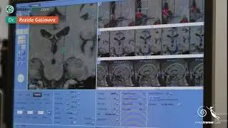 Parkinson&rsquo;s tremor ultrasound treatment allows precision targeting of brain with a 0.1 mm step