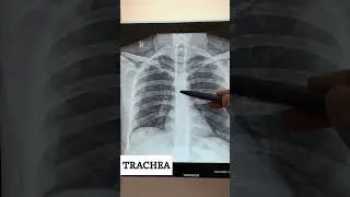 CHEST X-RAY BASICS #xrayclasses #physiotherapy