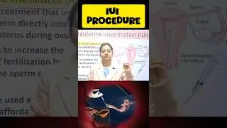 iui procedure #iui #fertilitytreatment #pregnancy #education