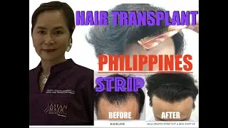 Strip FUT and FUE,Hair Transplant procedures  in the Philippines and Asia.