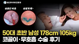 50대 초반 남자 178cm 105kg 코골이 수술 후기