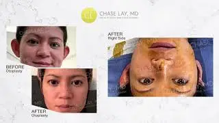 The Simple Visualization of the Otoplasty Universe with #ChaseLayMD!