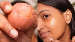Remove DARK SPOTS, ACNE SCARS, PIMPLE MARKS, PIGMENTATION