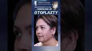 7 months after Otoplasty (ear reshaping surgery)