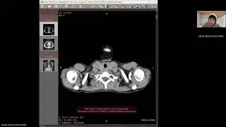 Anatomia de Torax en Tomograf&iacute;a Computarizada.