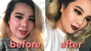 my noselift story | HelenOnFleek