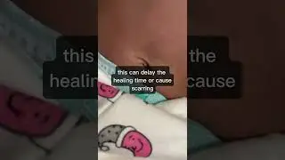 Why you should not pull the cord stump off | Newborn Umbilical cord care #shorts #baby #cute