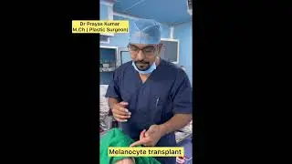 Melanocyte Transplant / Stable Vitiligo / Sudeep Hospital , City Light , Surat