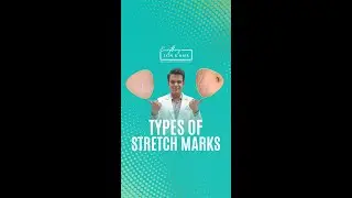 Types of Stretch Marks