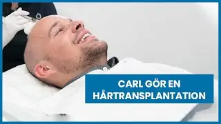 Hårtransplantation - Carls berättelse| Nordic Hair